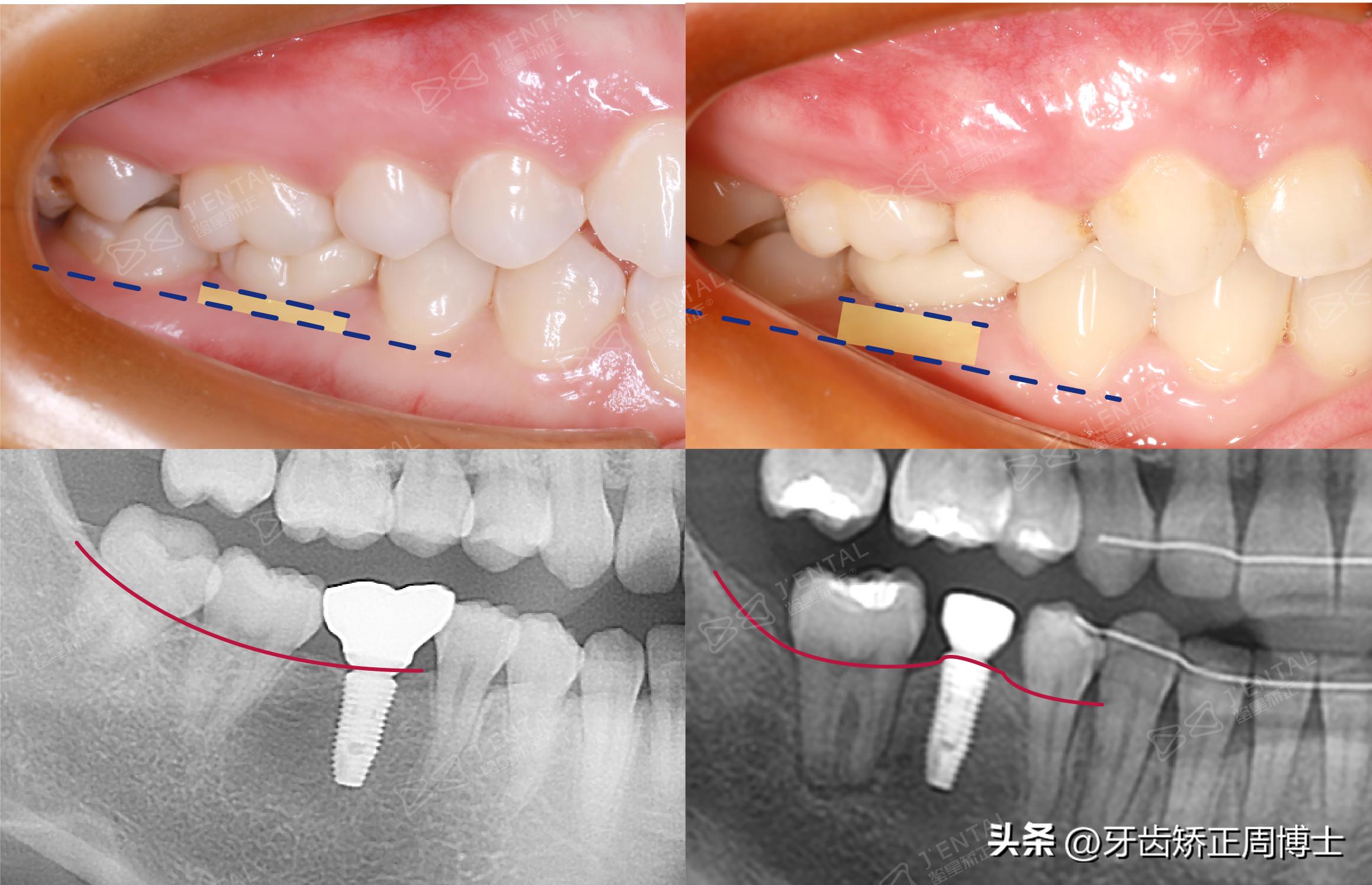 下巴后缩，深度解析与应对之道（知乎篇）