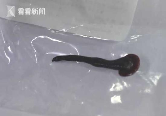 幼童做雾化咳出蚂蝗，深度探究与应对之策