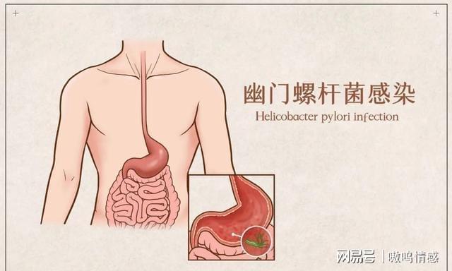 研究揭示，定期换筷子可降低胃癌发病率