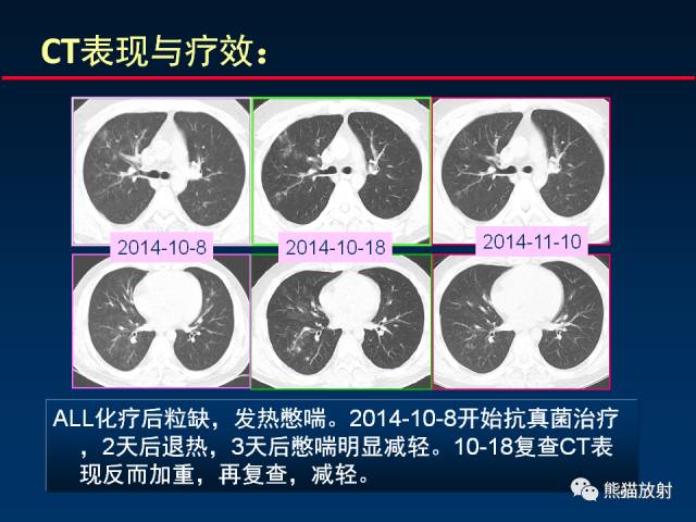 大爷节前大扫除后感染肺曲霉病的警示与反思