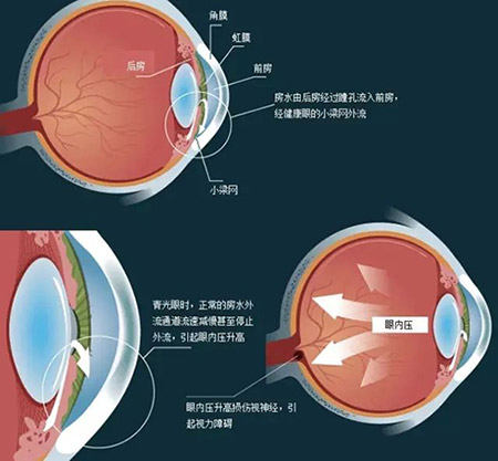 三种情况小心青光眼，预防胜于治疗