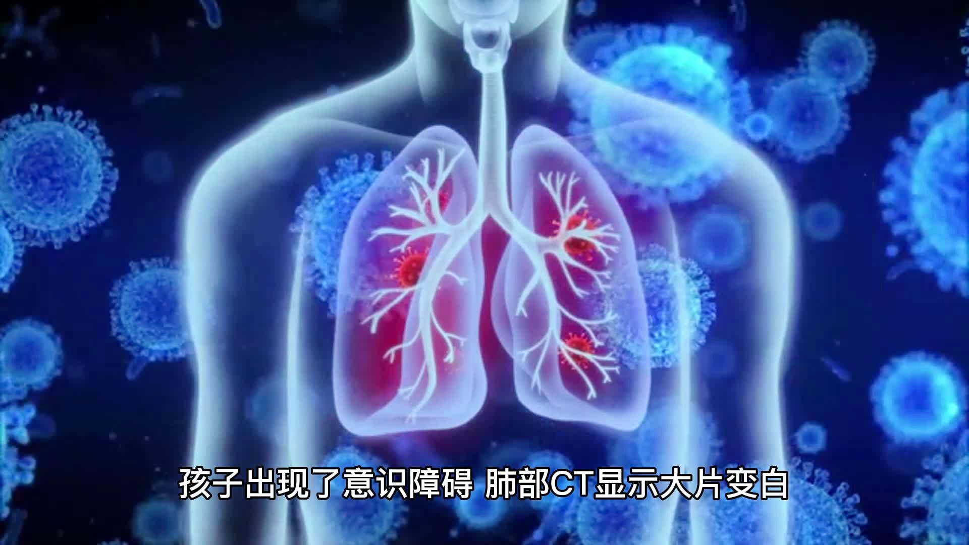 感染流感几天现白肺，成因、症状与防治策略