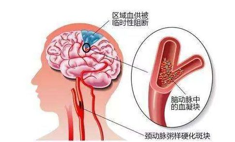 脑梗发作前身体三大部位可能变硬，警惕早期征兆与预防策略